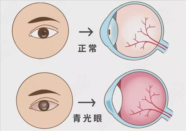 先天性青光眼怎么确诊有哪些症状呢(先天性青光眼怎么确诊有哪些症状图片)