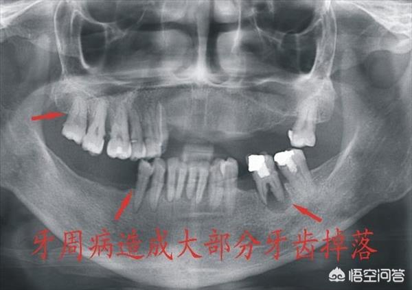 有牙周炎，并且牙齿松动，是保牙还是拔牙？(有牙周炎,并且牙齿松动,是保牙还是拔牙好)