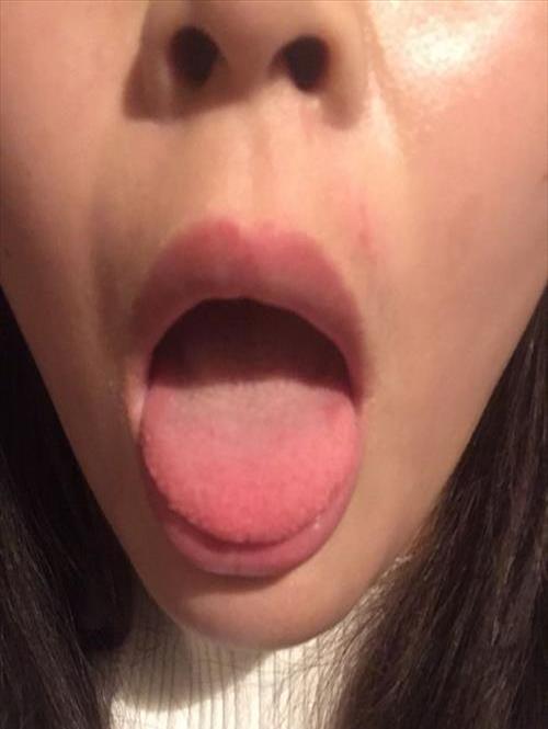 舌头上没有舌苔(关联：有舌苔怎么办)